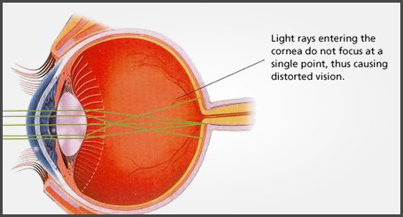 astigmatism