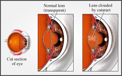 cataract_1