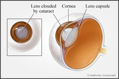 cataract_3