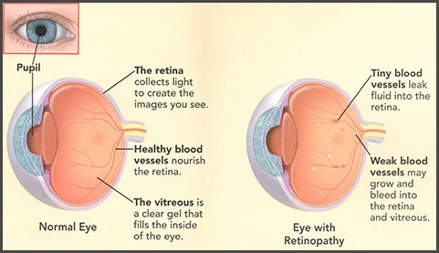 diabetes_2