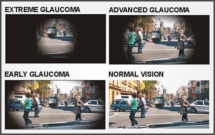 glaucoma_1