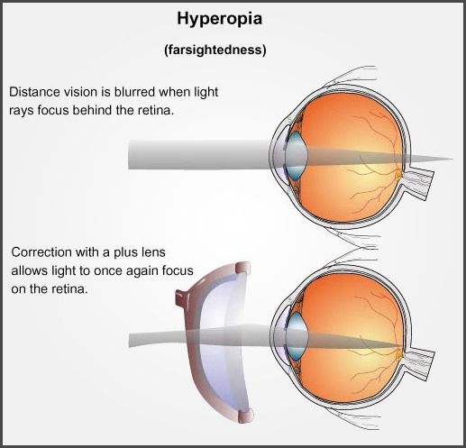 hyperopia