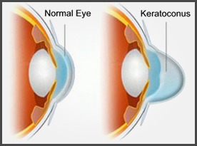 keratoconus-1