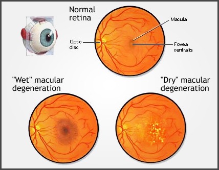 macular_deg_1