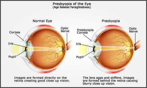 presbyopia